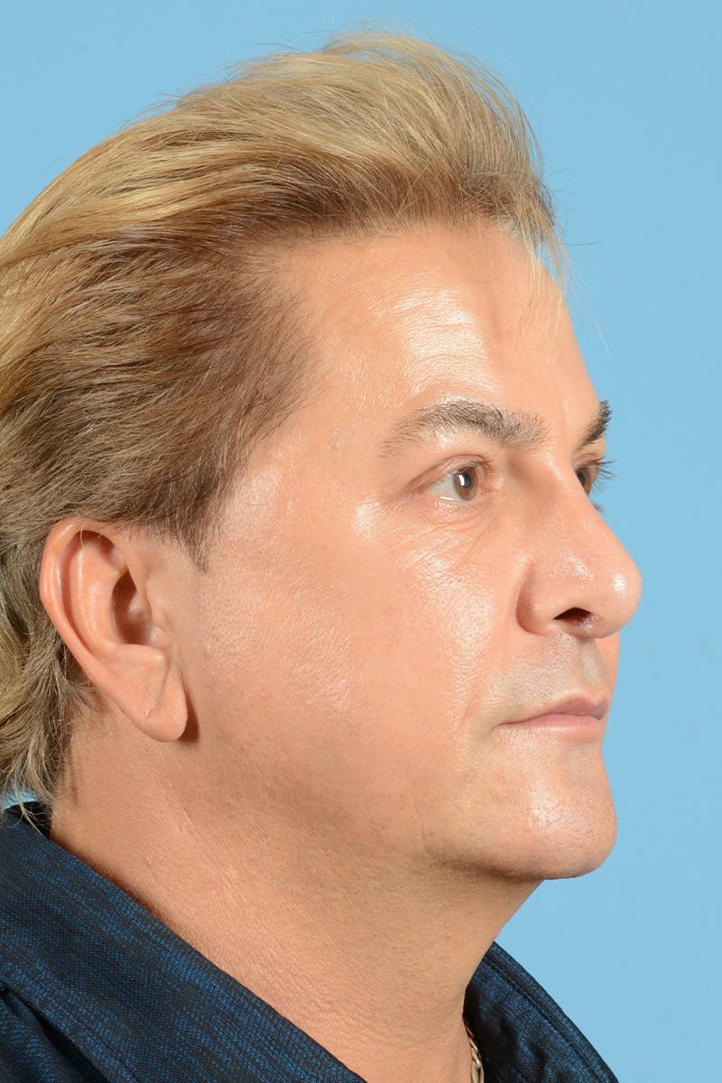 Eyelid Lift Before & After Gallery - Patient 343970 - Image 3