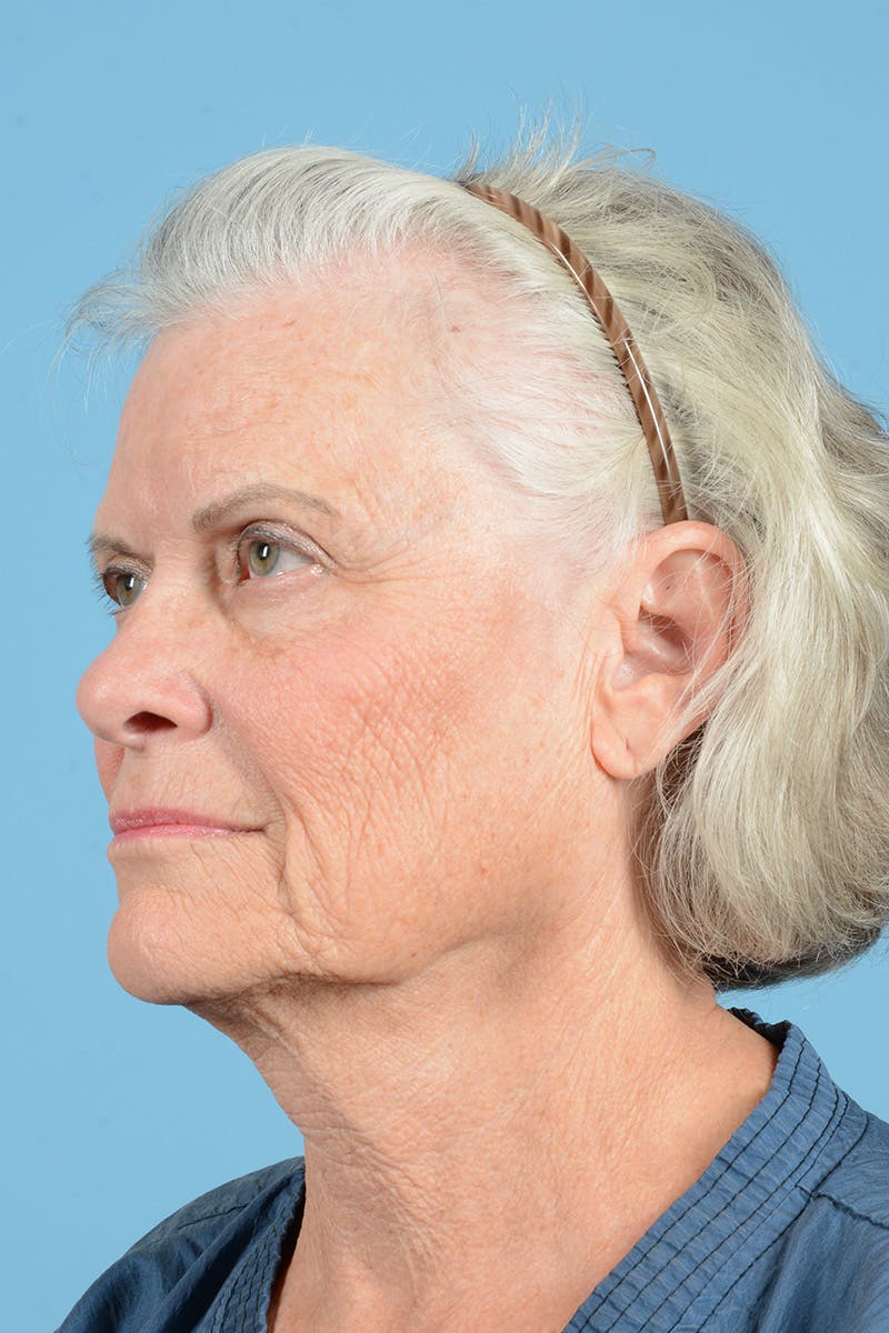 Facelift Before & After Gallery - Patient 734536 - Image 7