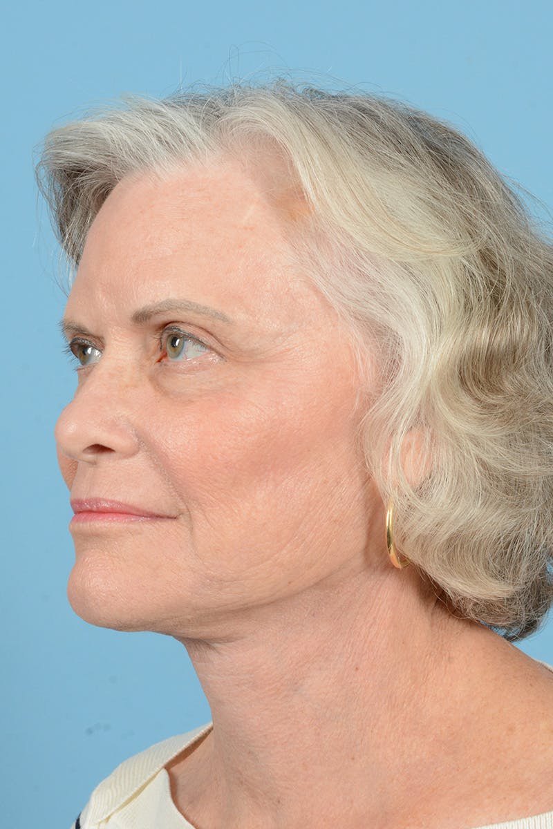 Facelift Before & After Gallery - Patient 734536 - Image 8