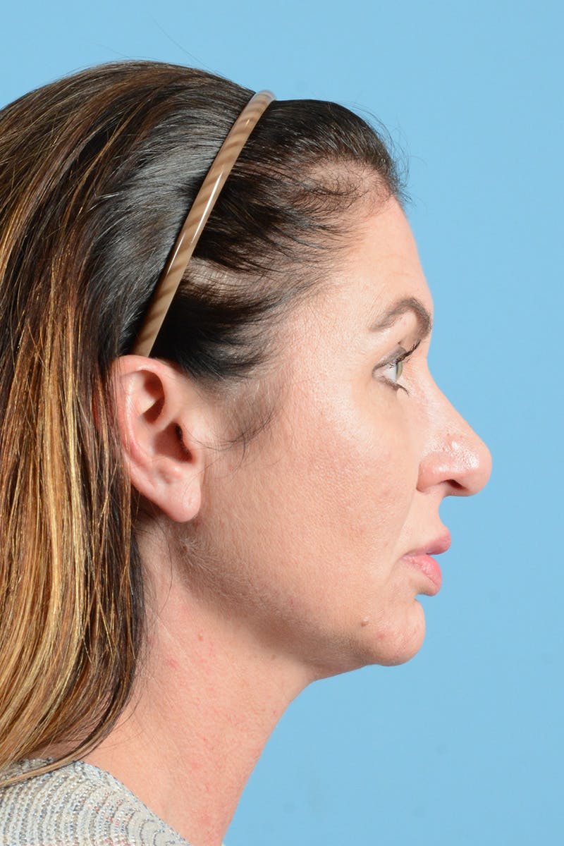 Eyelid Lift Before & After Gallery - Patient 343970 - Image 5