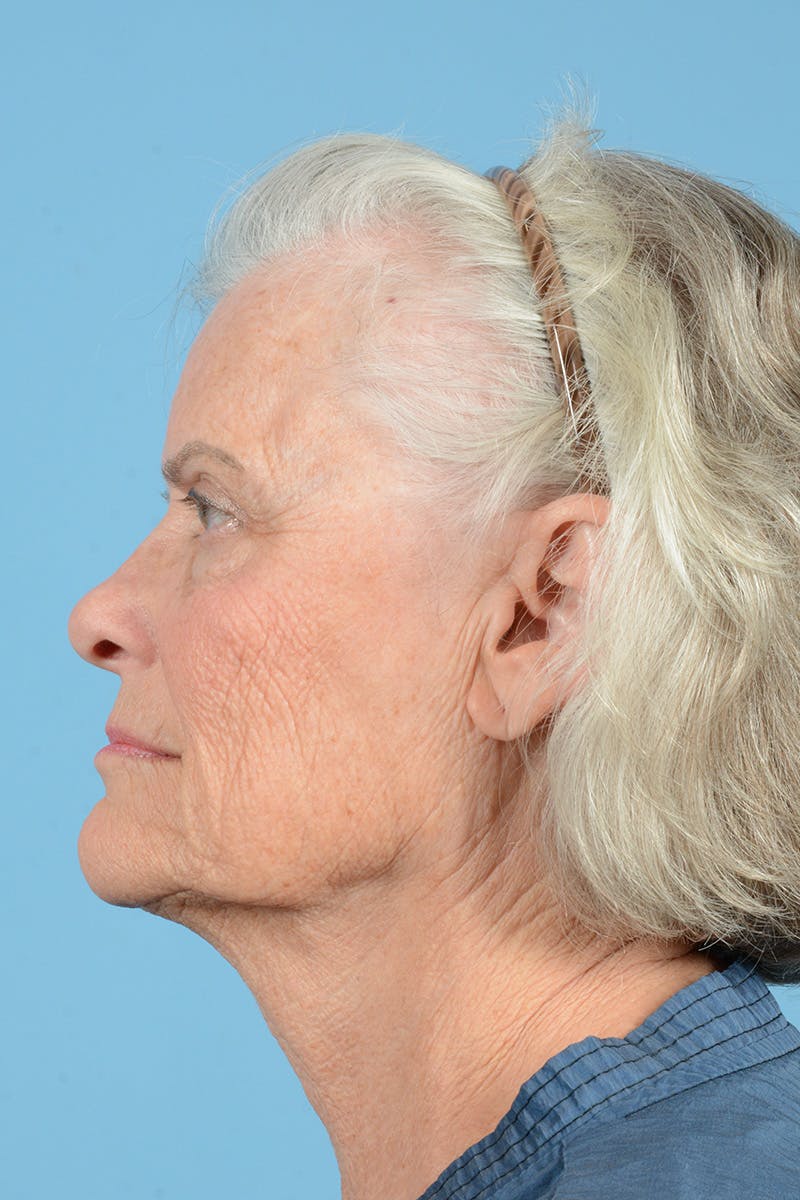 Facelift Before & After Gallery - Patient 734536 - Image 9