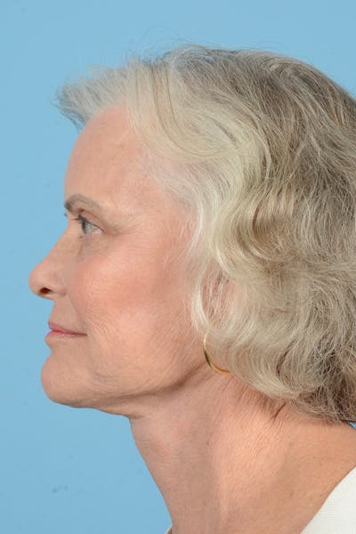Facelift Before & After Gallery - Patient 734536 - Image 10