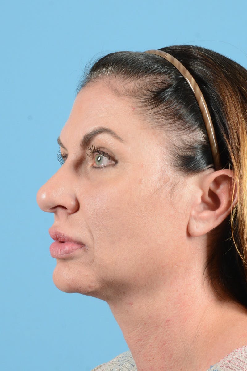 Eyelid Lift Before & After Gallery - Patient 343970 - Image 7