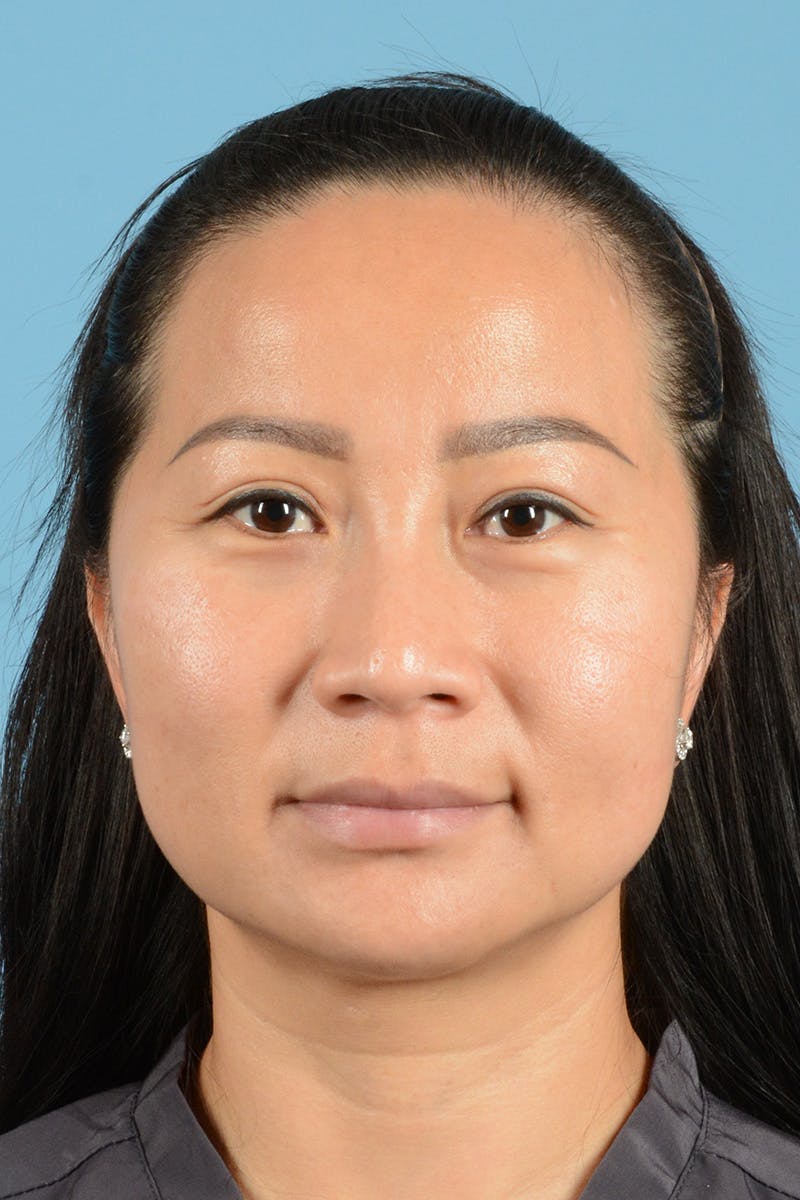 Facelift Before & After Gallery - Patient 415553 - Image 1