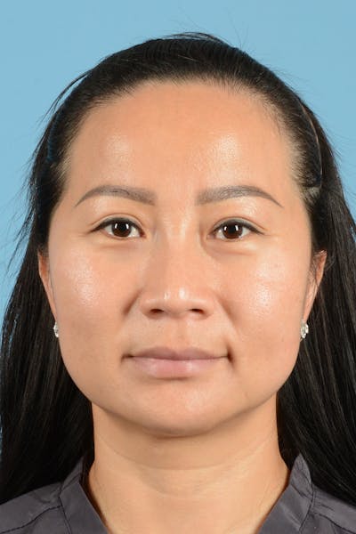 Facelift Before & After Gallery - Patient 415553 - Image 1