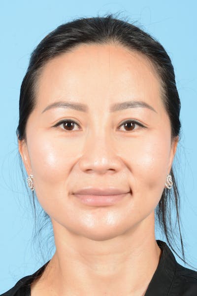 Facelift Before & After Gallery - Patient 415553 - Image 2