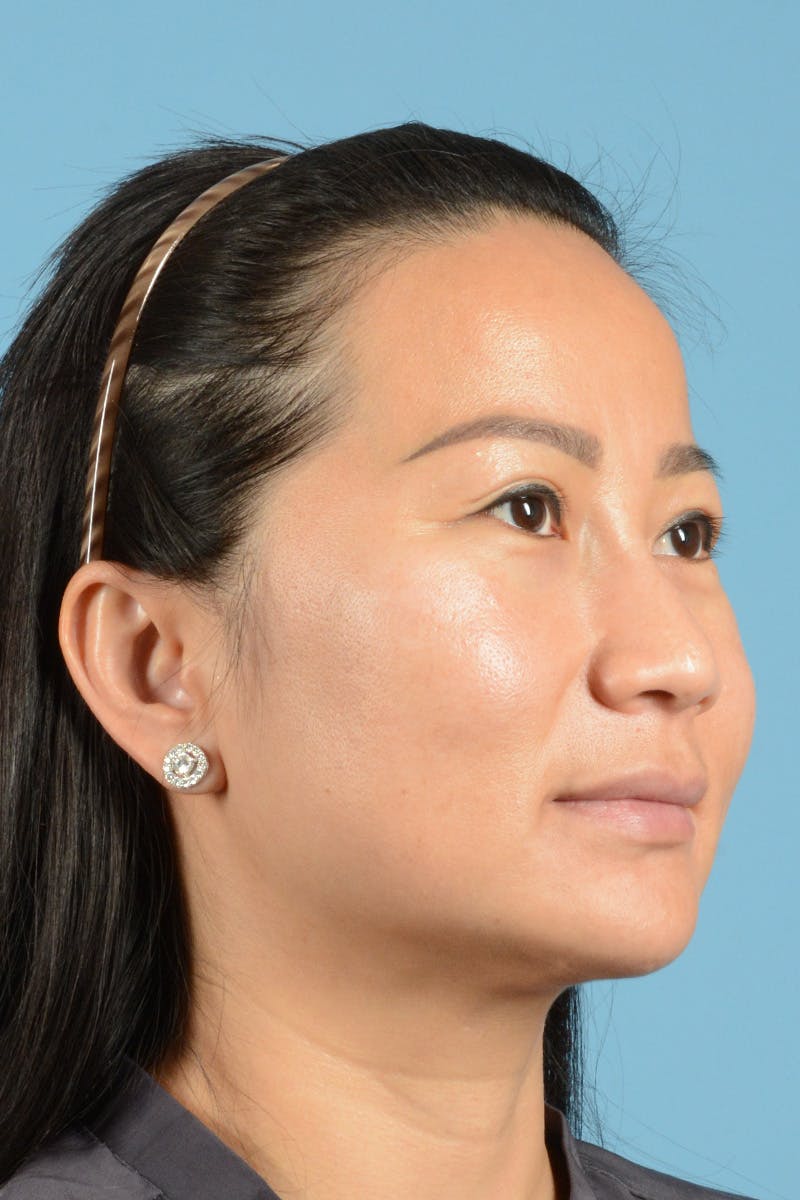 Facelift Before & After Gallery - Patient 415553 - Image 3