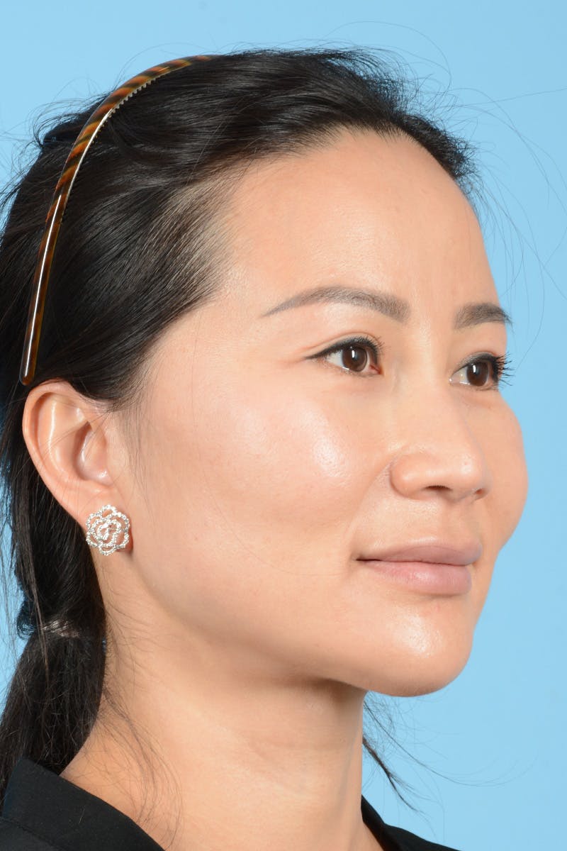 Facelift Before & After Gallery - Patient 415553 - Image 4