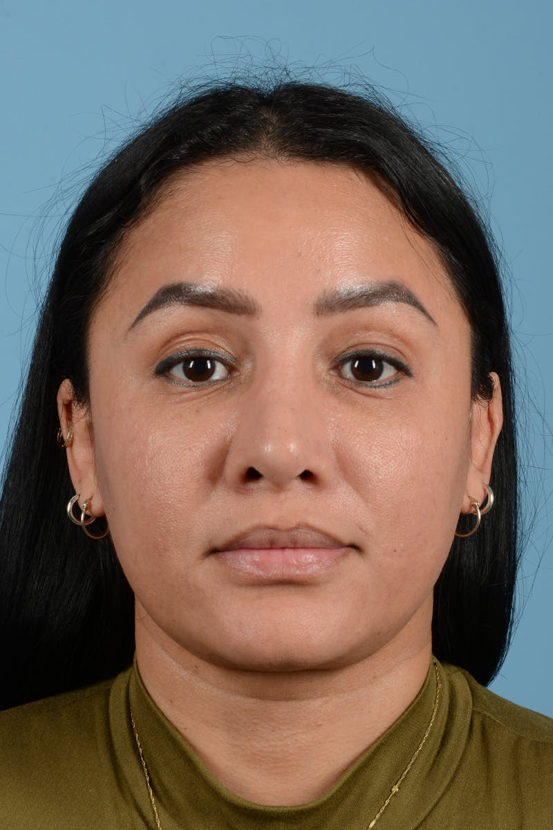 Facial Augmentation Before & After Gallery - Patient 173324 - Image 2