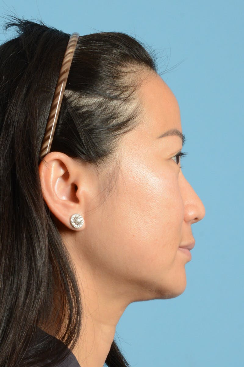 Facelift Before & After Gallery - Patient 415553 - Image 5