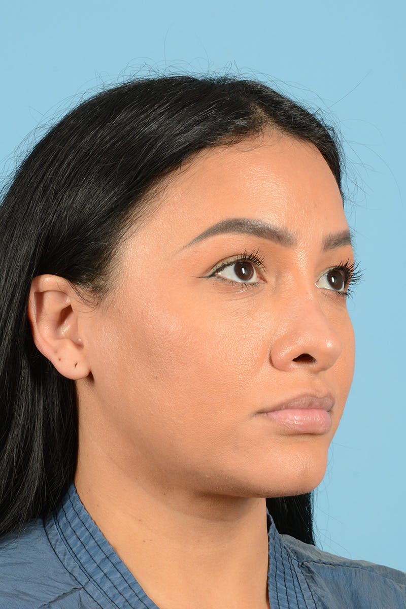 Facial Augmentation Before & After Gallery - Patient 173324 - Image 3