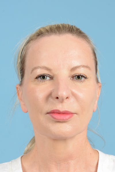 Eyelid Lift Before & After Gallery - Patient 296040 - Image 1