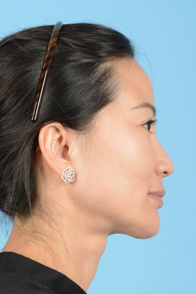 Facelift Before & After Gallery - Patient 415553 - Image 6