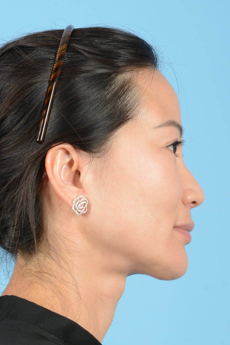 Facelift Before & After Gallery - Patient 415553 - Image 6