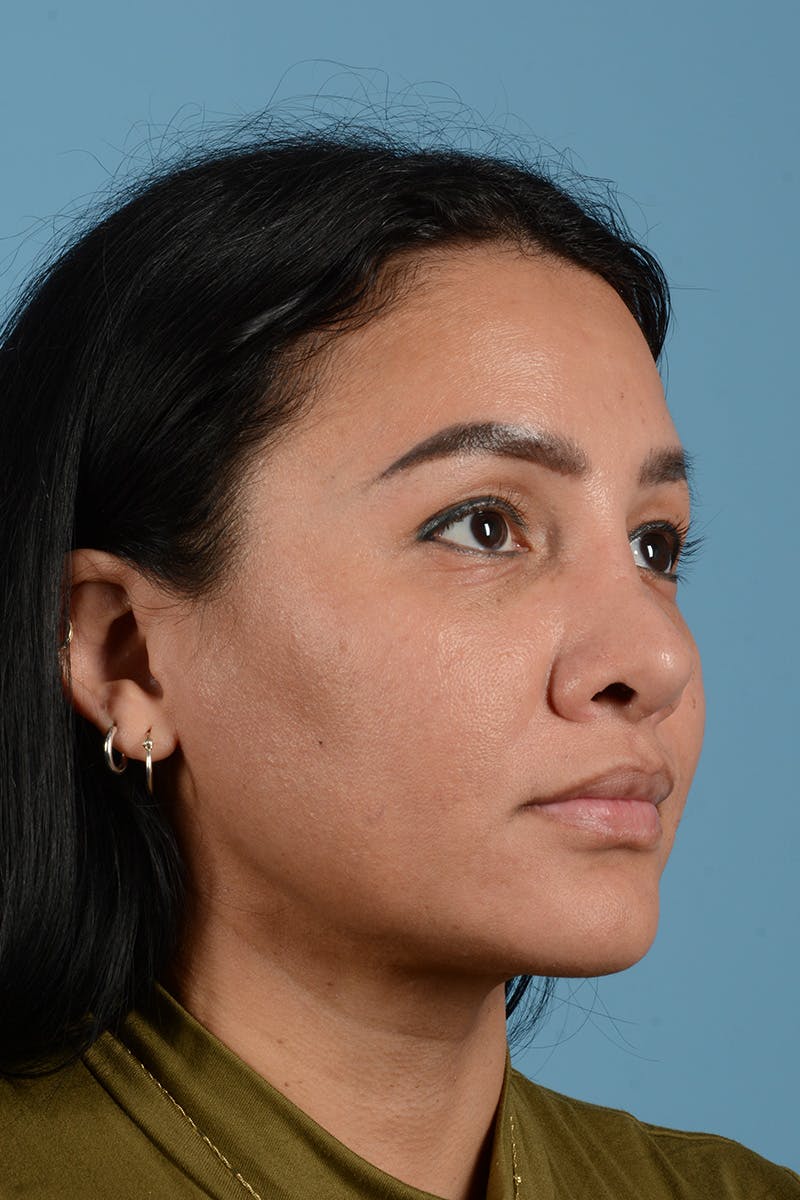 Facial Augmentation Before & After Gallery - Patient 173324 - Image 4