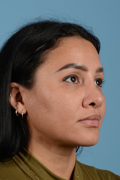 Facial Augmentation Before & After Gallery - Patient 173324 - Image 4