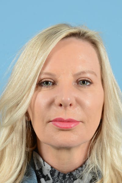 Eyelid Lift Before & After Gallery - Patient 296040 - Image 2