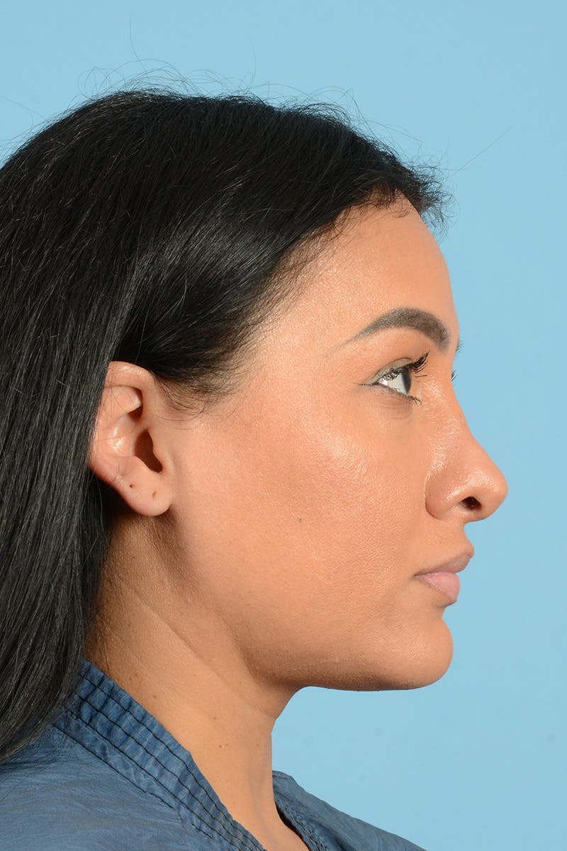 Facial Augmentation Before & After Gallery - Patient 173324 - Image 5