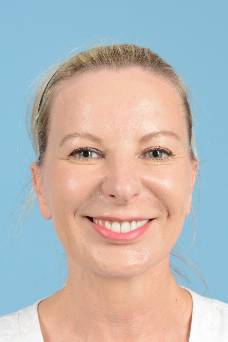 Eyelid Lift Before & After Gallery - Patient 296040 - Image 3