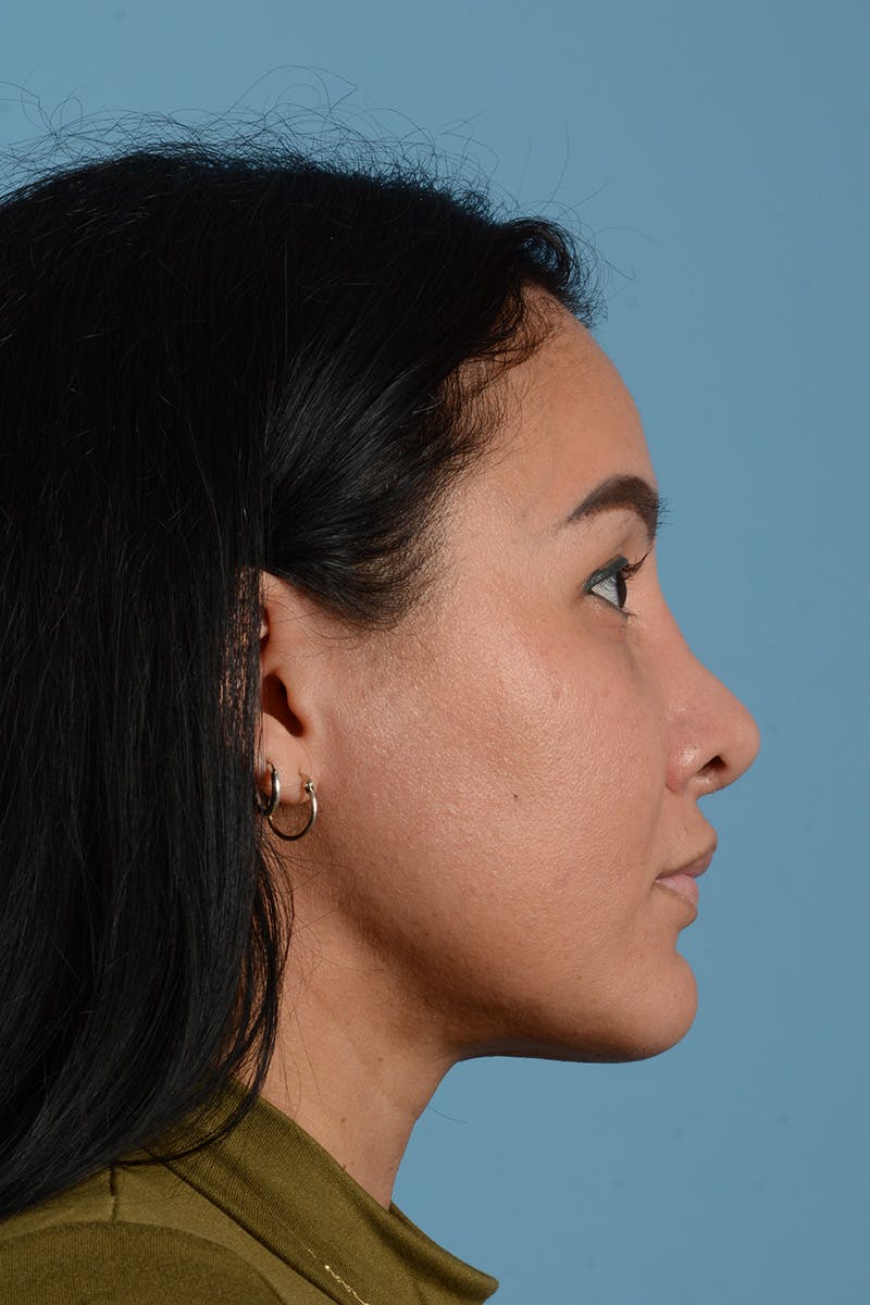 Facial Augmentation Before & After Gallery - Patient 173324 - Image 6