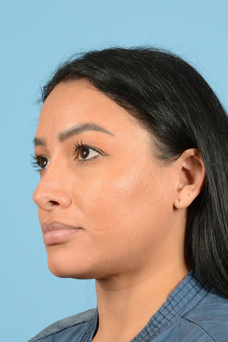 Facial Augmentation Before & After Gallery - Patient 173324 - Image 7