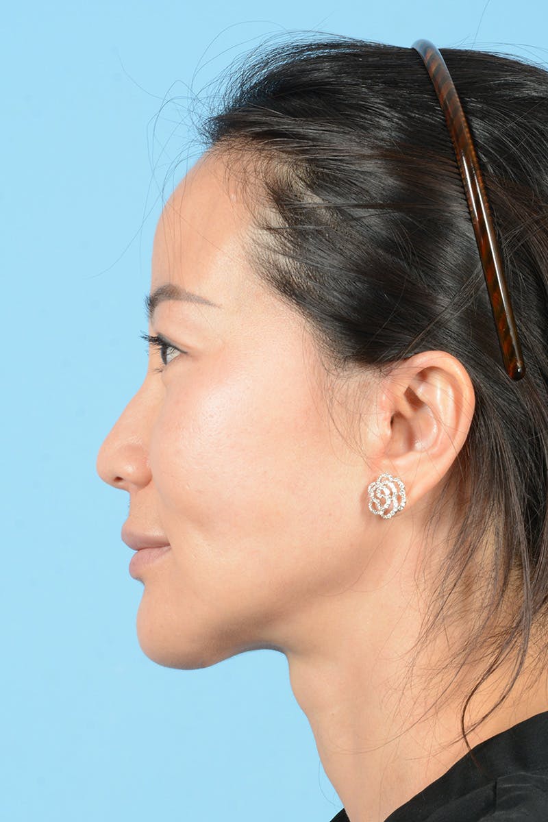 Facelift Before & After Gallery - Patient 415553 - Image 10