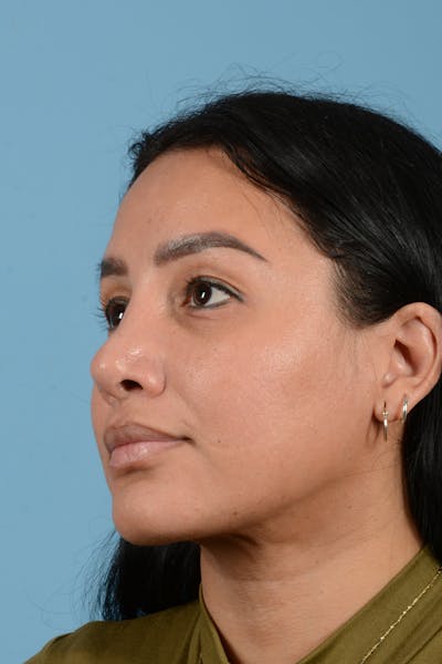 Facial Augmentation Before & After Gallery - Patient 173324 - Image 8