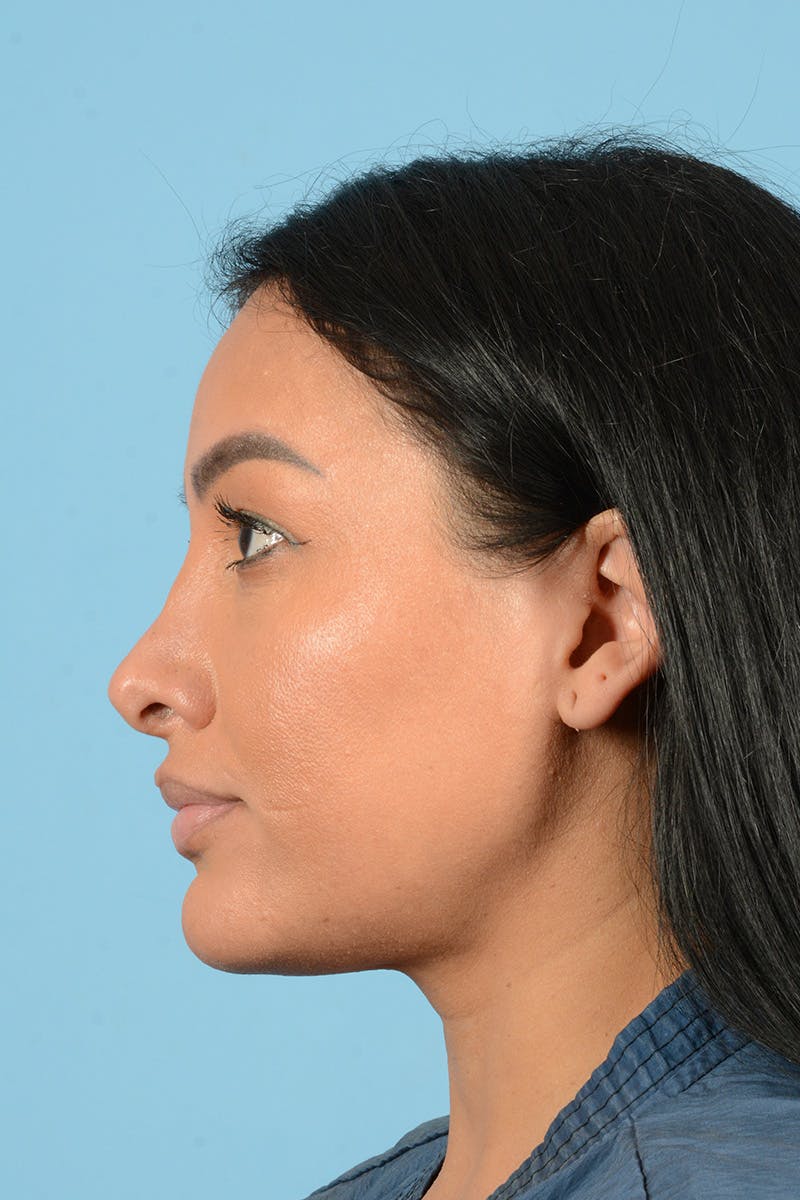 Facial Augmentation Before & After Gallery - Patient 173324 - Image 9