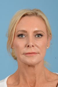Facelift Before & After Gallery - Patient 152162 - Image 1
