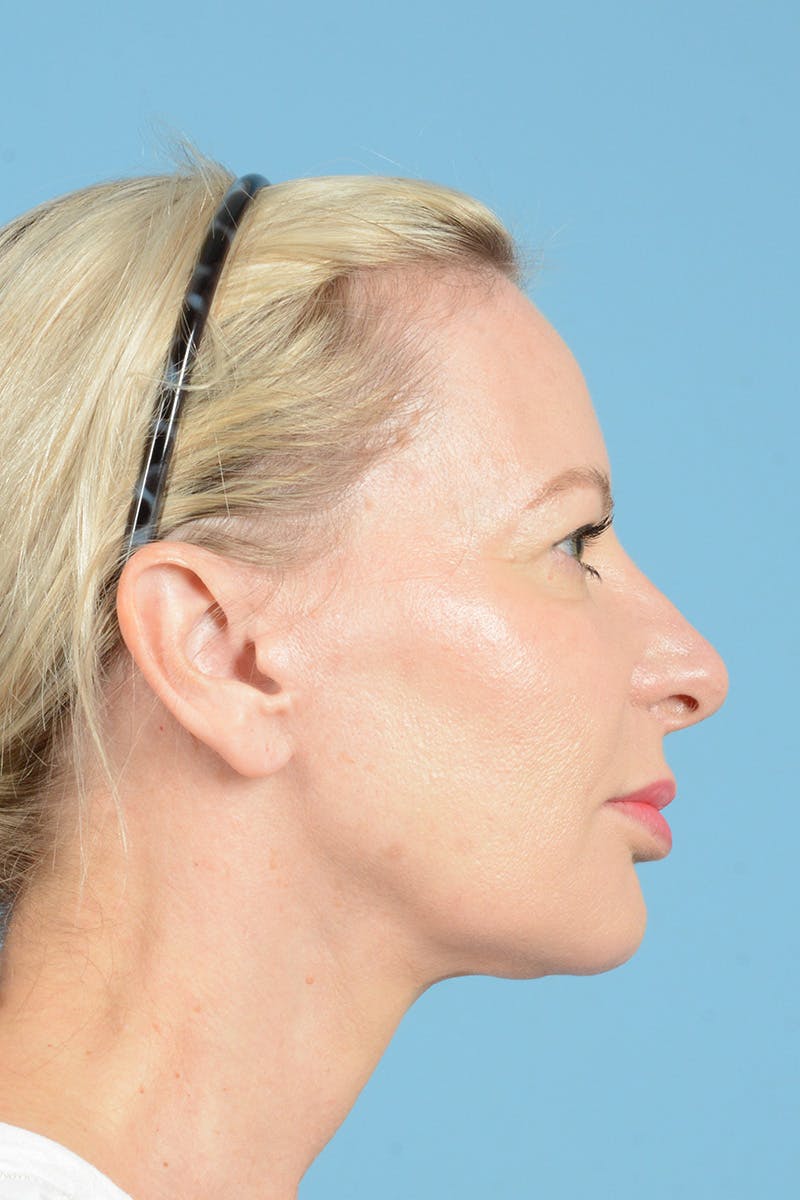 Eyelid Lift Before & After Gallery - Patient 296040 - Image 7