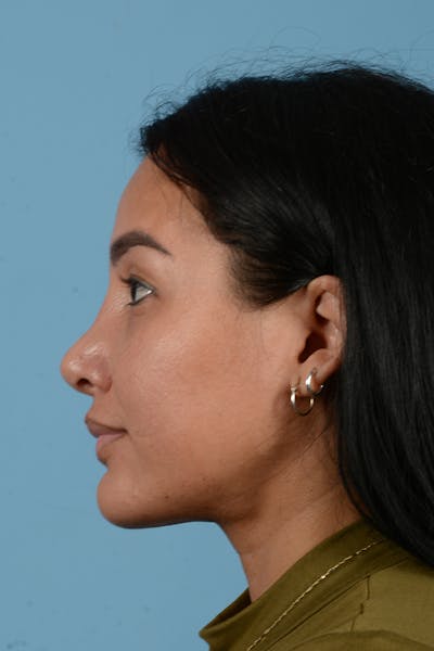 Facial Augmentation Before & After Gallery - Patient 173324 - Image 10