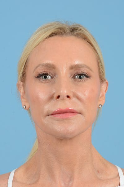 Facelift Before & After Gallery - Patient 152162 - Image 2