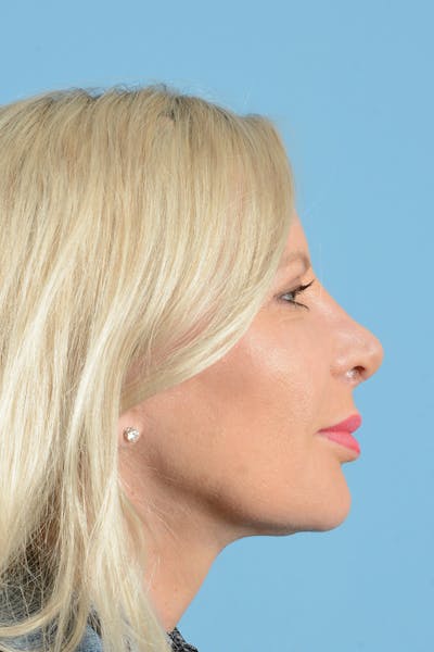 Eyelid Lift Before & After Gallery - Patient 296040 - Image 8