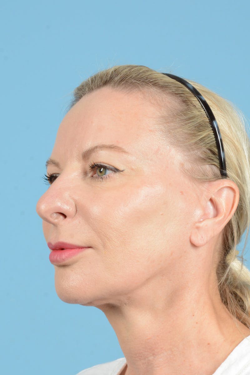 Eyelid Lift Before & After Gallery - Patient 296040 - Image 9
