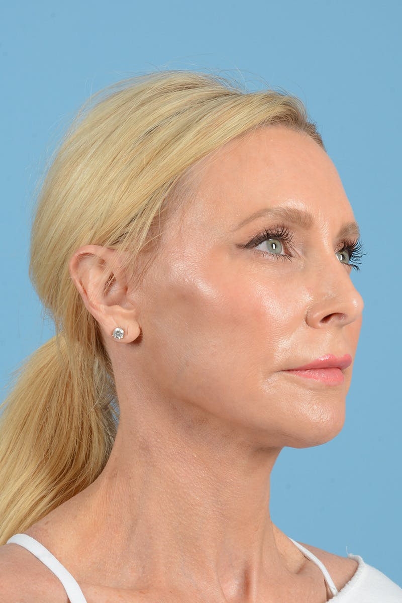 Facelift Before & After Gallery - Patient 152162 - Image 4