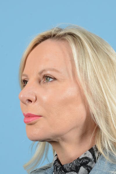 Eyelid Lift Before & After Gallery - Patient 296040 - Image 10