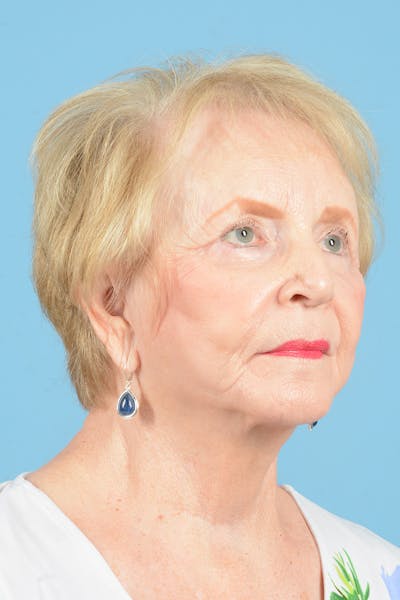 Facial Augmentation Before & After Gallery - Patient 337560 - Image 4