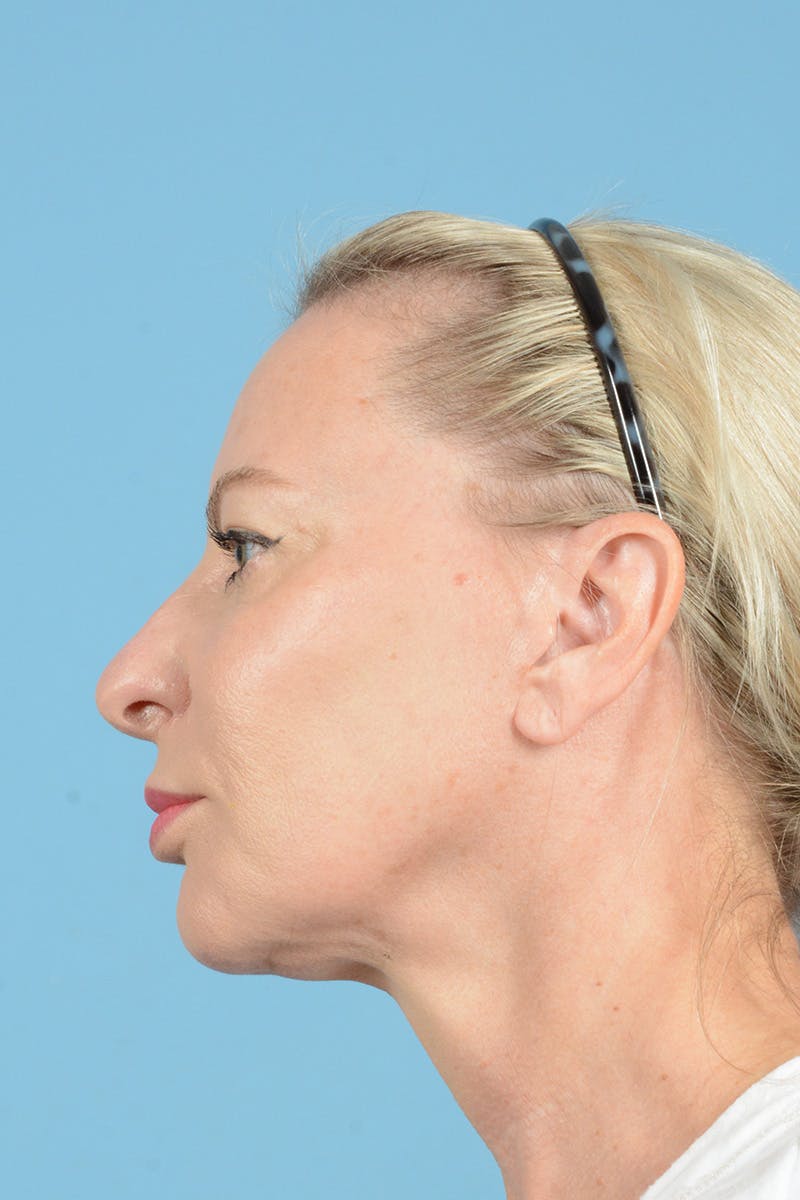 Eyelid Lift Before & After Gallery - Patient 296040 - Image 11