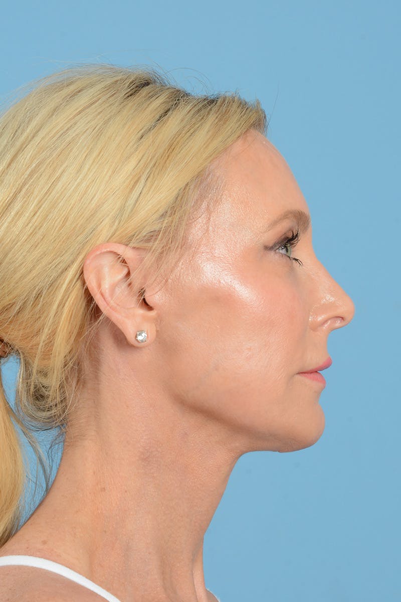 Facelift Before & After Gallery - Patient 152162 - Image 6