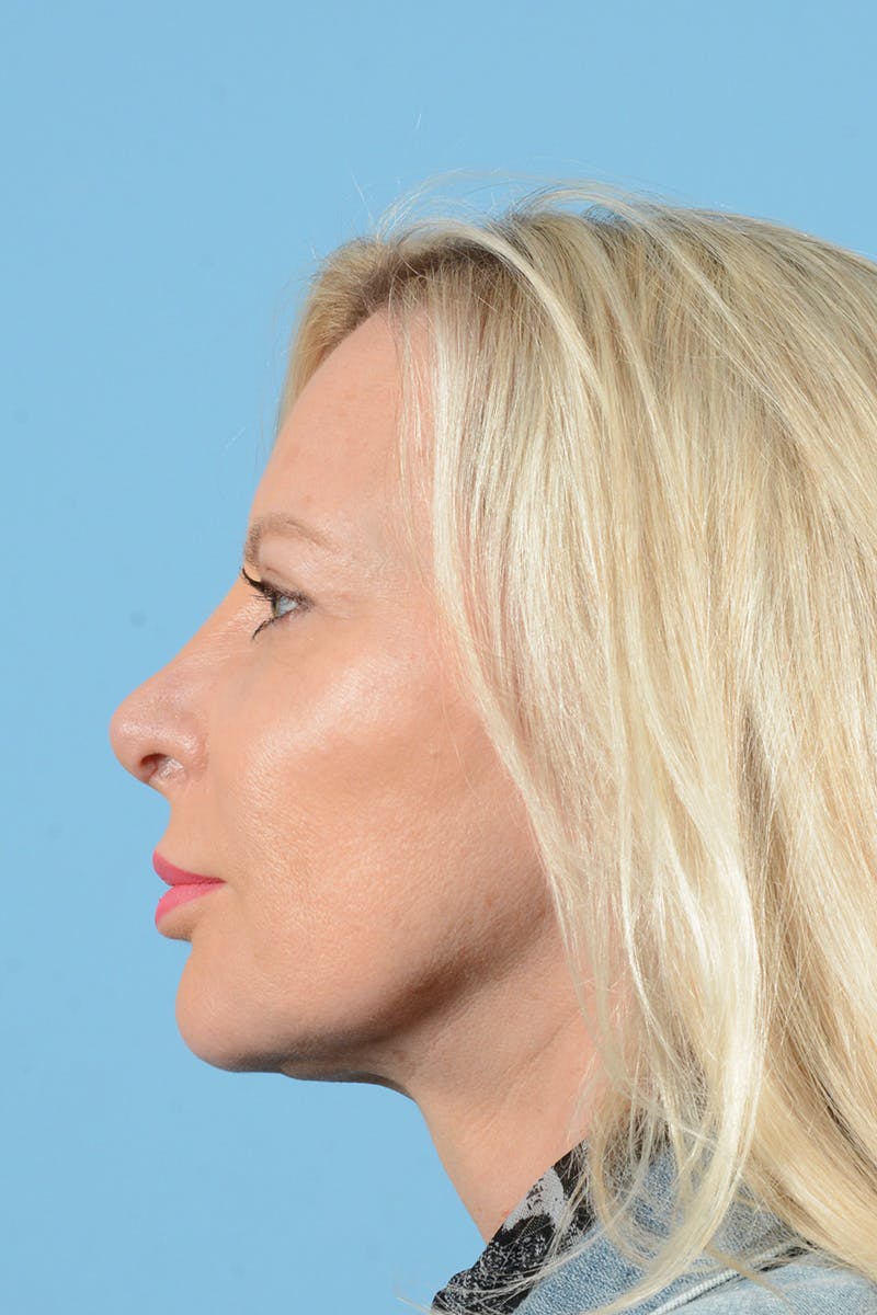Eyelid Lift Before & After Gallery - Patient 296040 - Image 12