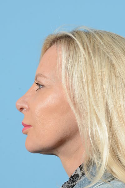 Eyelid Lift Before & After Gallery - Patient 296040 - Image 12