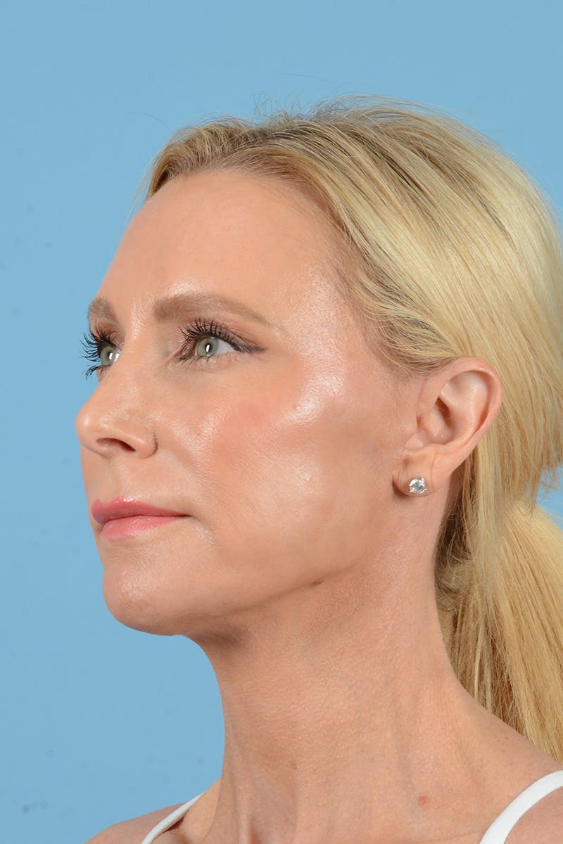 Facelift Before & After Gallery - Patient 152162 - Image 8