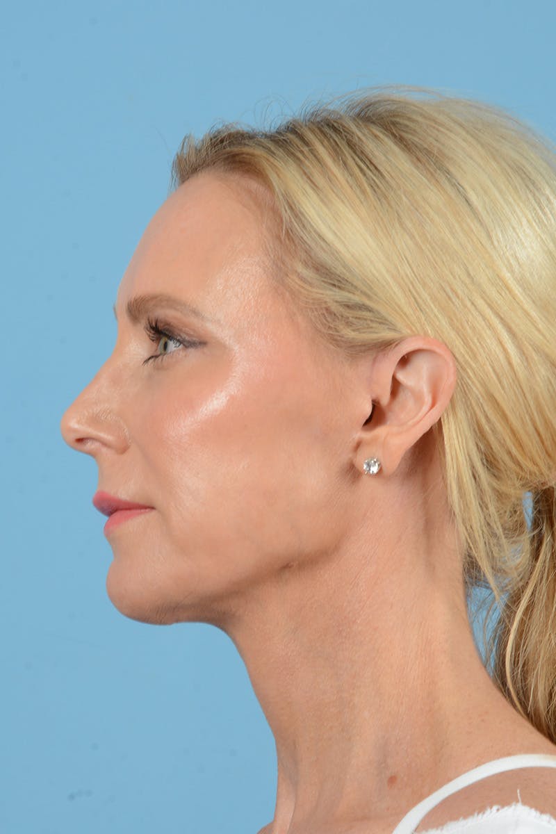 Facelift Before & After Gallery - Patient 152162 - Image 10