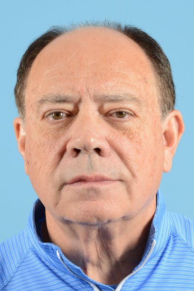 Facelift Before & After Gallery - Patient 196139 - Image 1