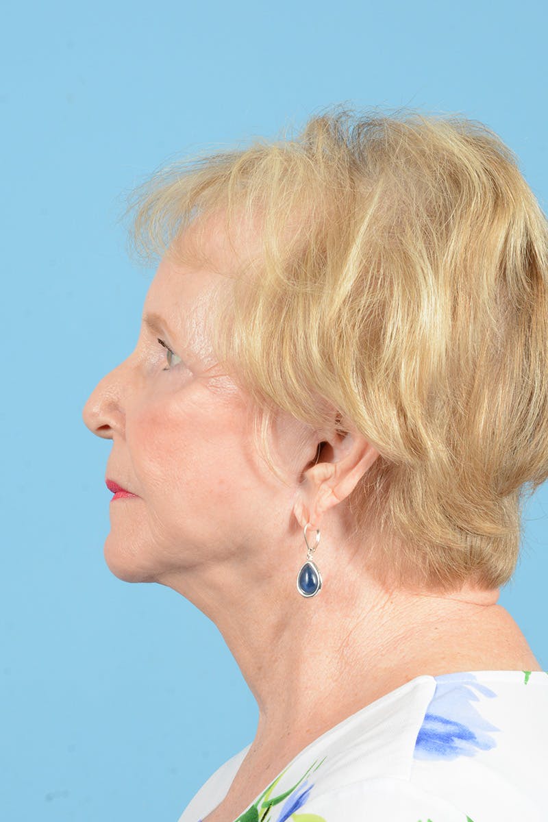 Facial Augmentation Before & After Gallery - Patient 337560 - Image 10