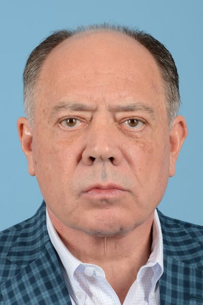 Facelift Before & After Gallery - Patient 196139 - Image 2