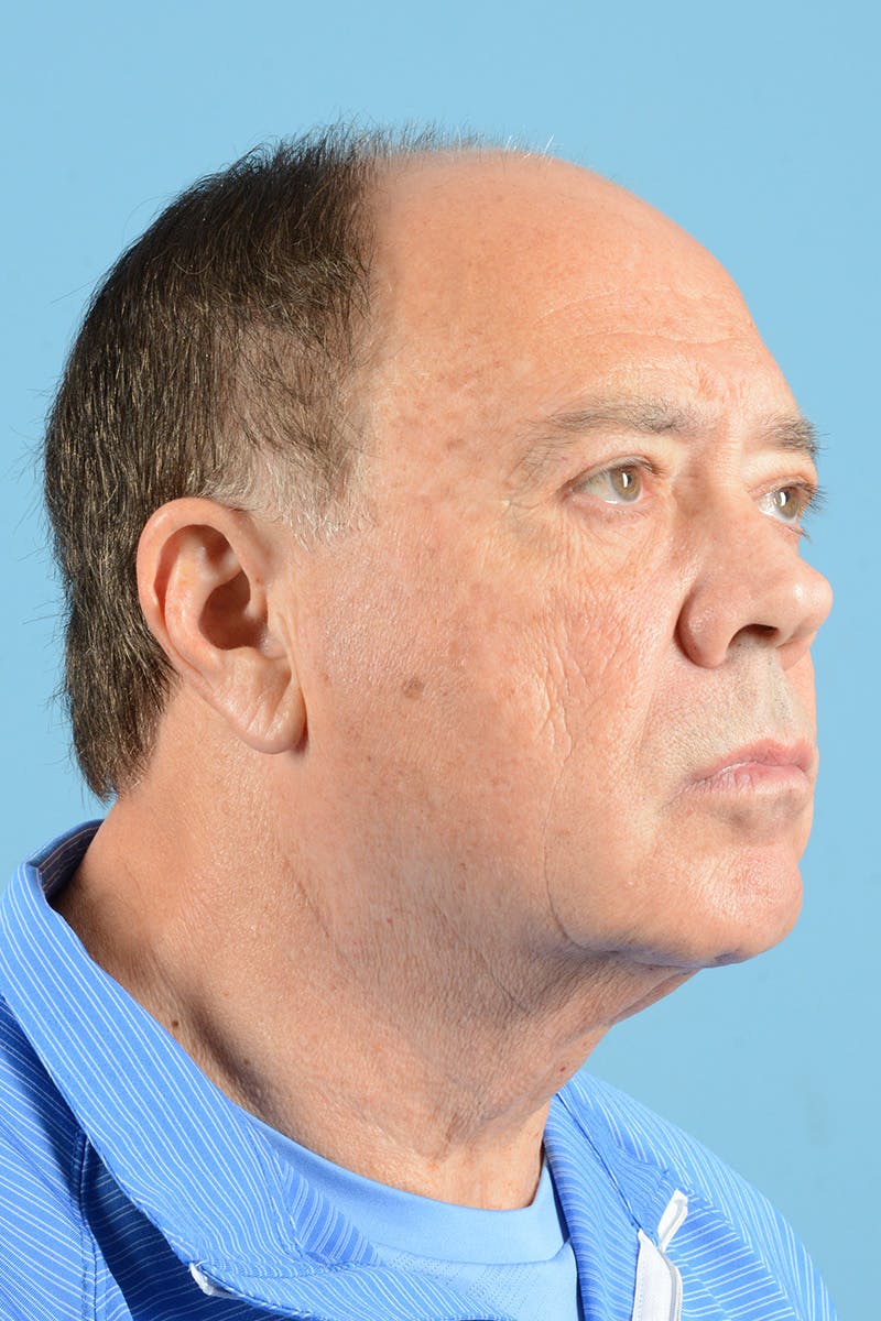 Facelift Before & After Gallery - Patient 196139 - Image 3