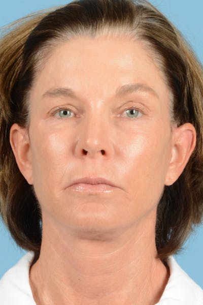 Facial Augmentation Before & After Gallery - Patient 324671 - Image 2