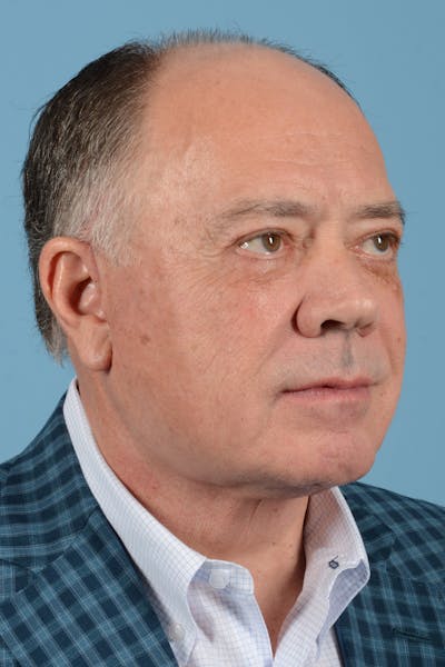 Facelift Before & After Gallery - Patient 196139 - Image 4