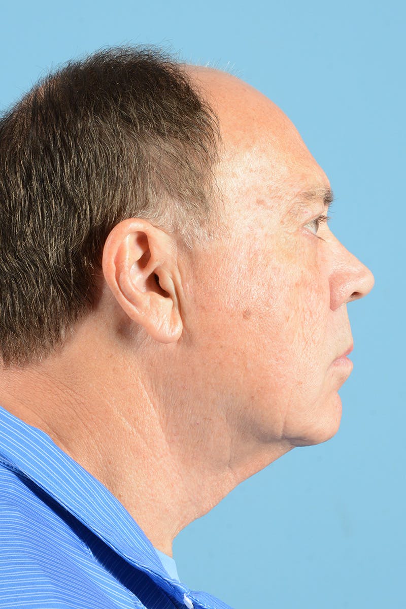 Facelift Before & After Gallery - Patient 196139 - Image 5